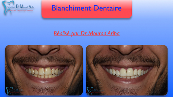 Blanchiment Dentaire