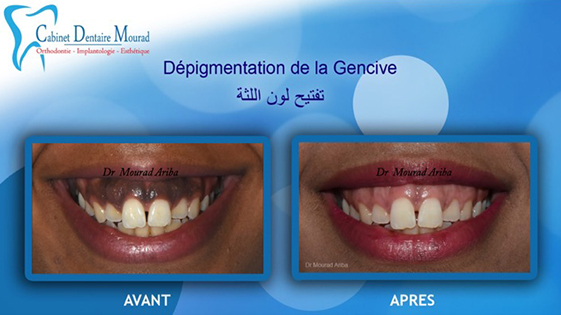 Depigmentation de la gencive