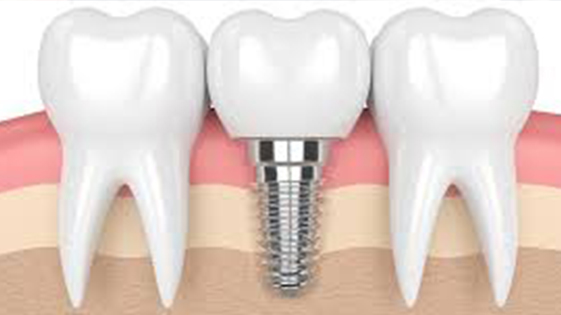 Implant dentaire